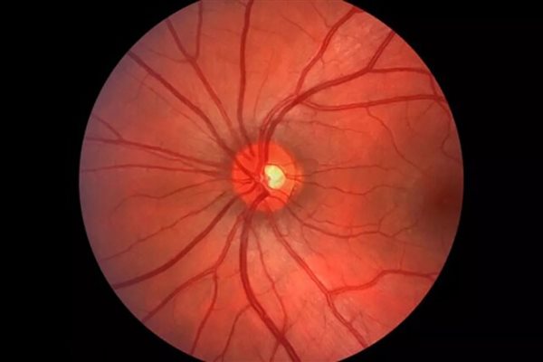 حفاظت از عصب بینایی با کمک سلول‌های پیش‌ساز عصبی